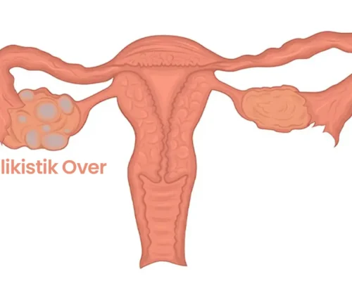 Polikistik Over Sendromu (PCOS) Nedir, Belirtileri Nelerdir?