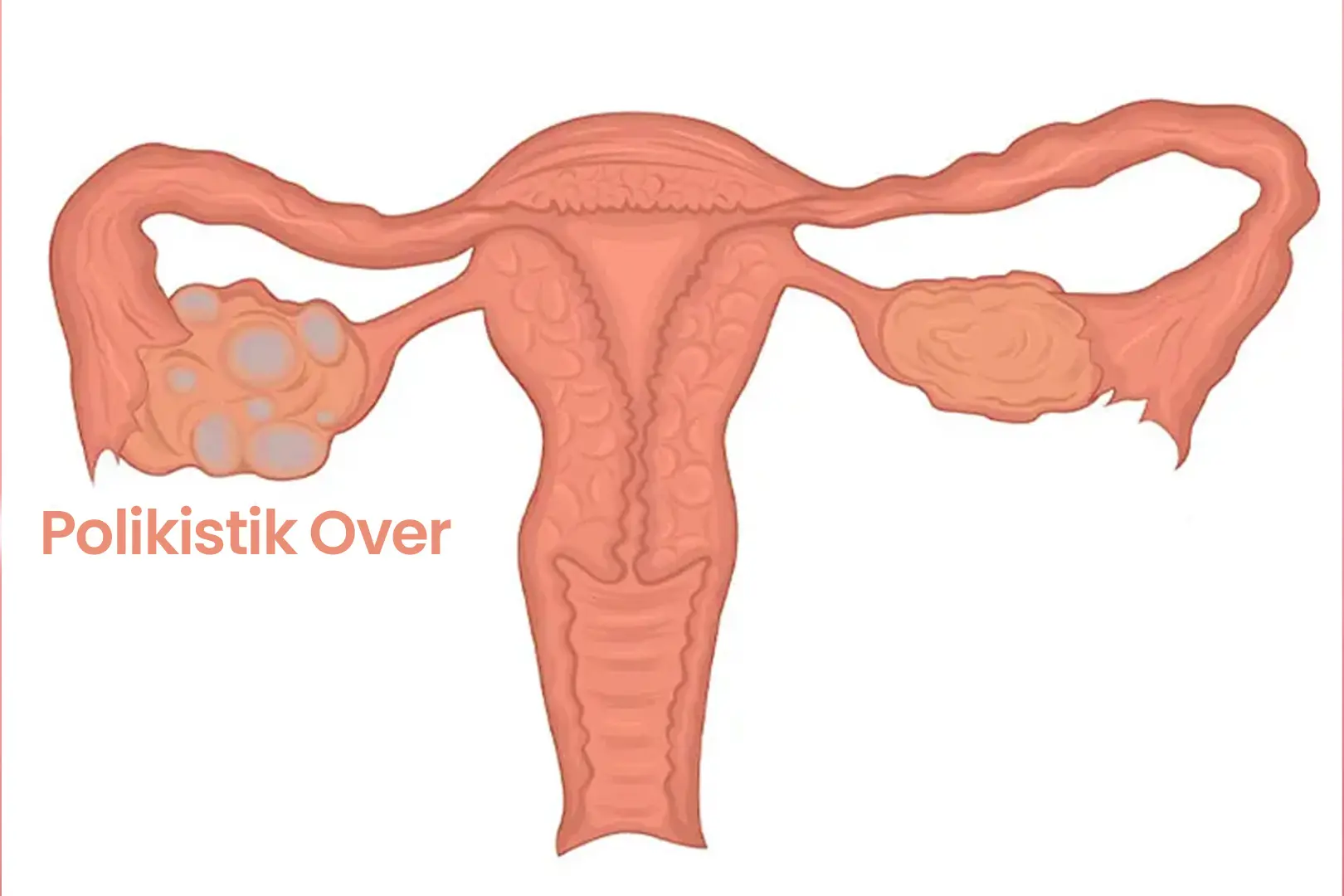 Polikistik Over Sendromu (PCOS) Nedir, Belirtileri Nelerdir?