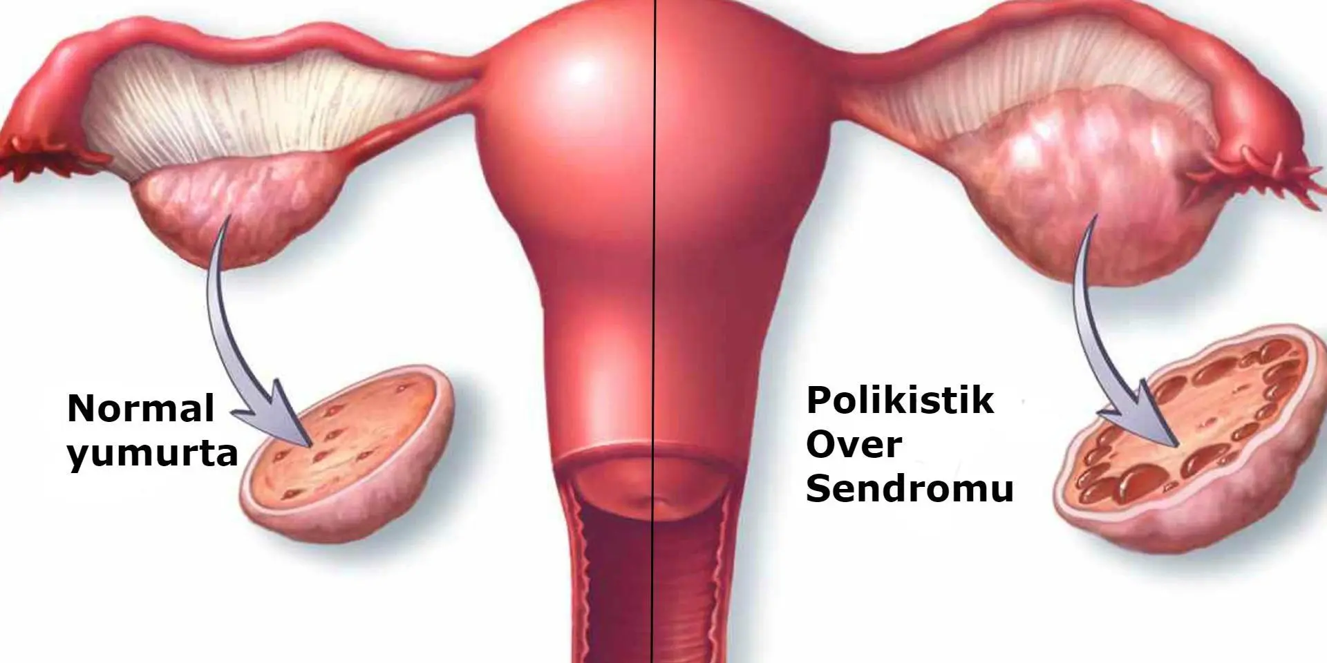 polistik over sendromu nedir