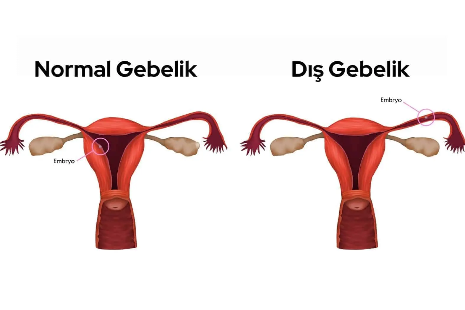 Dış Gebelik Nedir